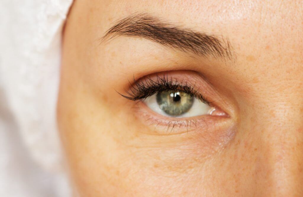 Ultherapy Under Eyes