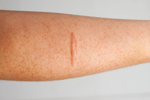laser scar removal